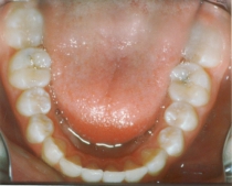Orthodontic Crowding After Lower