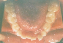 Orthodontic Crowding Before Lower