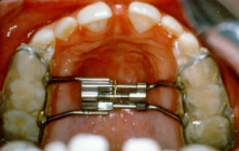 Orthodontic Crowding During Treatment 