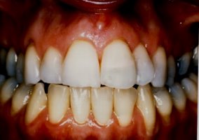 Closeup of After Teeth Bleaching