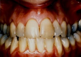 Closeup of Before Teeth Bleaching