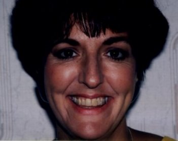 Smile Before Teeth Whitening