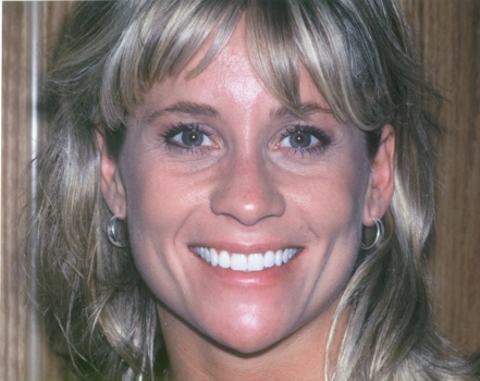 Smile After Teeth Whitening