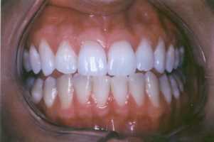 Closeup of After Teeth Bleaching