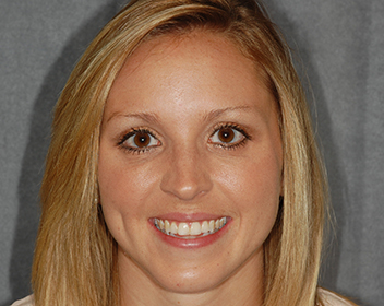 Smile Before Teeth Whitening