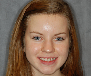 Before portrait of bonding to correct a missing lateral incisor