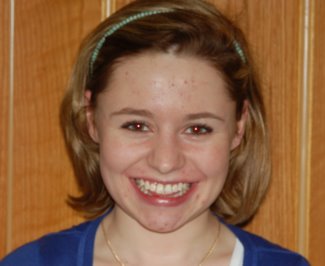 Smile of Patient With Flurosis Before Bonding