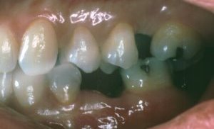 Left Side Missing Teeth