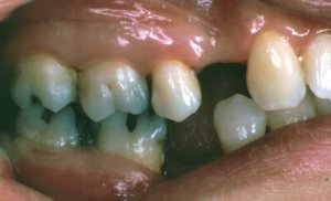 Right Side Missing Teeth