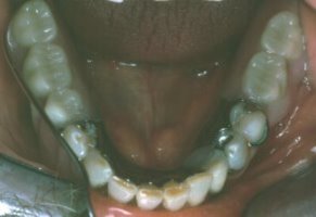 View of lower teeth with the new partial denture in place