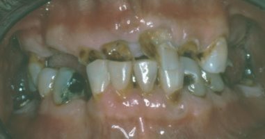 Front view of large cavities making the teeth non-restorable.