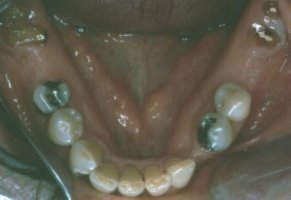 Lower arch has enough teeth to save for a partial denture.