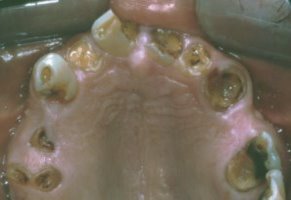 Upper teeth are unsalvageable