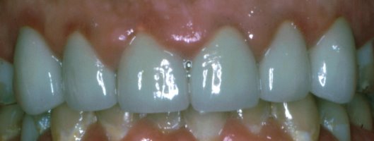 The porcelain crowns look great