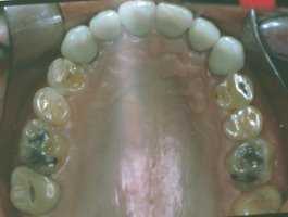 Upper view of a restored dentition with new crowns on the front teeth