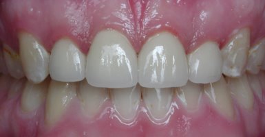 Teeth erosion repaired with porcelain crowns