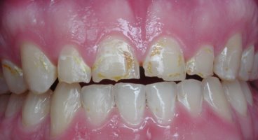 Teeth erosion damage