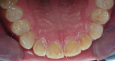 Teeth erosion damage