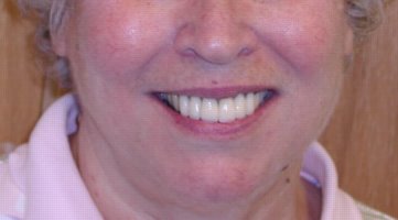 Teeth erosion repaired with porcelain crowns