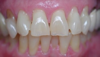 Teeth erosion damage
