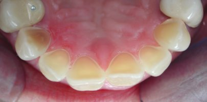Teeth erosion damage