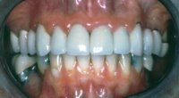 Teeth erosion repaired with porcelain crowns