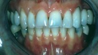 Teeth erosion damage
