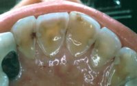 Teeth erosion damage