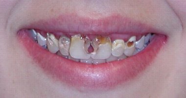 Not a very appealing smile with a large amount of tooth decay