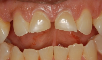 Teeth erosion damage