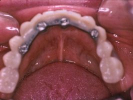 Dental implants with teeth affixed to them