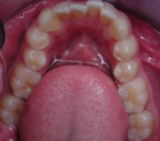 Invisalign Atlanta before clear braces