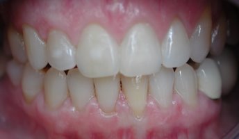 Close gap with invisible braces after picture