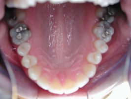 Close gap with invisible braces after upper view