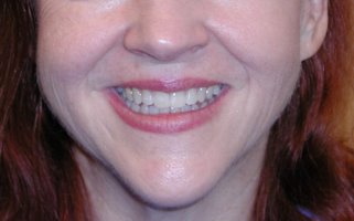 Smile after gap is closed with invisible braces