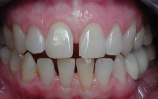 Close gap with invisible braces before picture