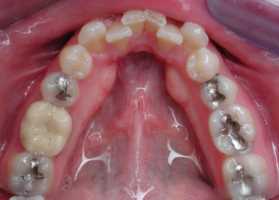 Invisalign Lilburn before clear braces