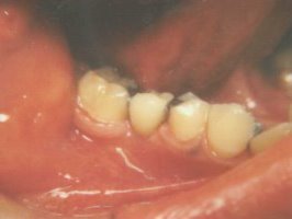 Side view of a Maryland bridge replacing a back tooth