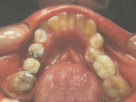 Chewing surface view of a Maryland bridge