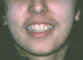 Happy patient after her crowded teeth were straightened with braces