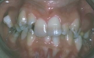 Crooked teeth front view