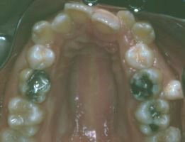 Crooked teeth upper chewing surface view