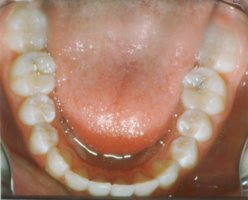 Crooked teeth after being straightened with retainers only