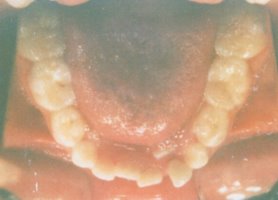 Crooked teeth before being straightened with retainers only