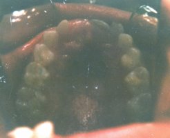 Crooked teeth before being straightened with retainers only