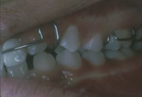 A retainer is used to guide the canine teeth into the proper position