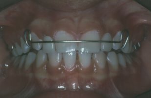 A retainer is used to guide the canine teeth into the proper position