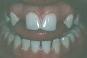 A retainer is used to guide the canine teeth into the proper position