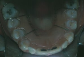 A retainer is used to guide the canine teeth into the proper position