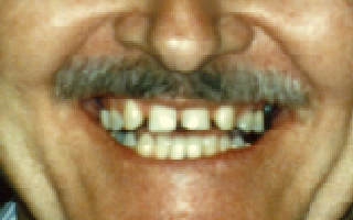 Before picture of a patient with congenitally missing lateral incisor teeth